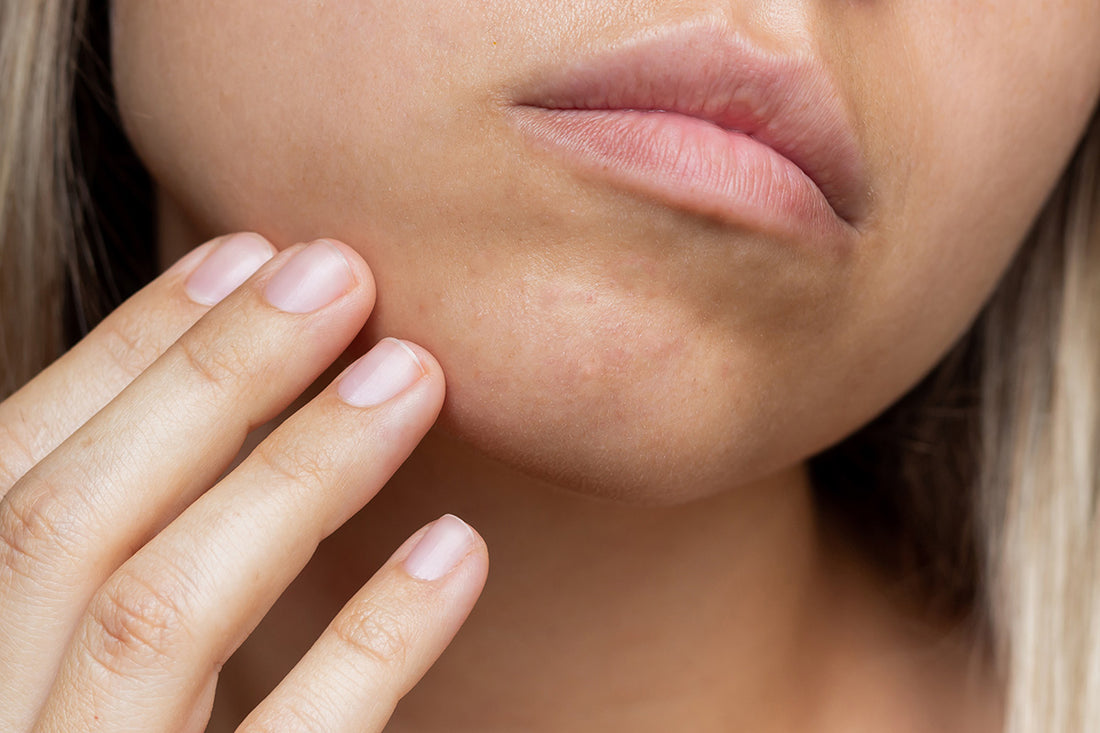 Understanding Skin Sensitivity and How to Care for it